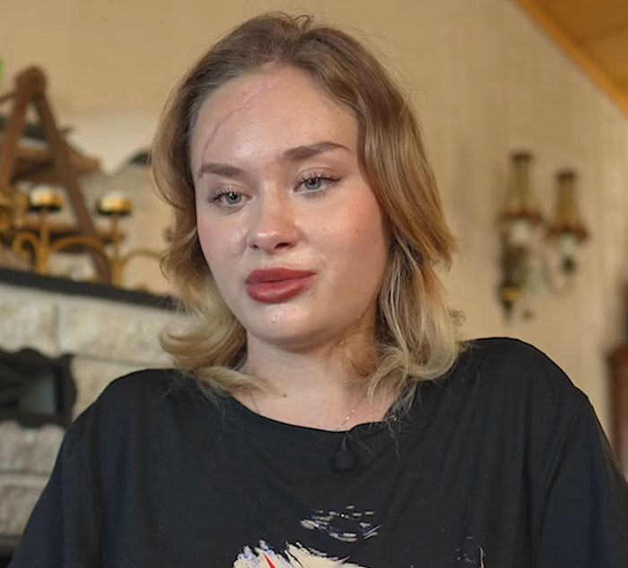 Ukrainian model with visible facial injuries speaking about party before attack, seated indoors in casual black shirt - 4