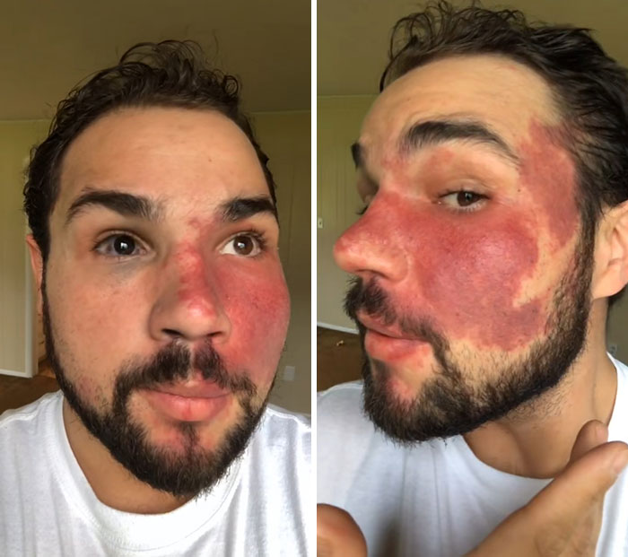 Man with a large, red birthmark covering half of his face, showing an interesting and unique birth mark pattern.