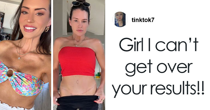 Woman Spends $14K on Mommy Makeover in Turkey After U.S. Quotes Hit $40K