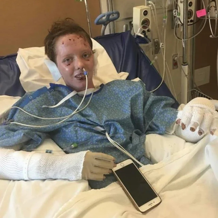 Woman burned in gas station explosion lying in hospital bed with bandaged hands and medical tubes attached. - 4