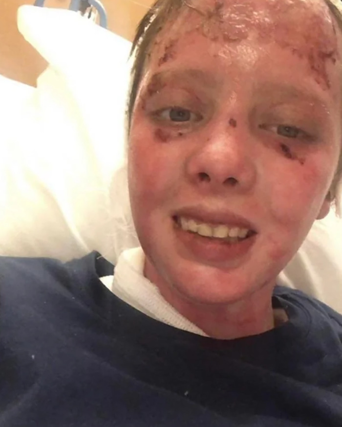 Woman burned in gas station explosion with visible facial scars, lying in a hospital bed and smiling faintly. - 5