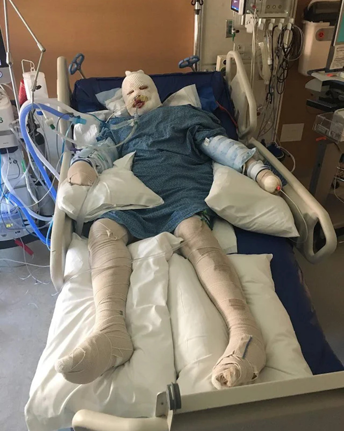 Woman burned in gas station explosion lying in hospital bed with bandages and medical equipment in a recovery room. - 1