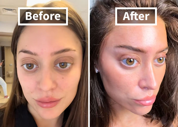 Young woman before and after facelift at 28, highlighting changes in facial appearance and skin texture. - 1