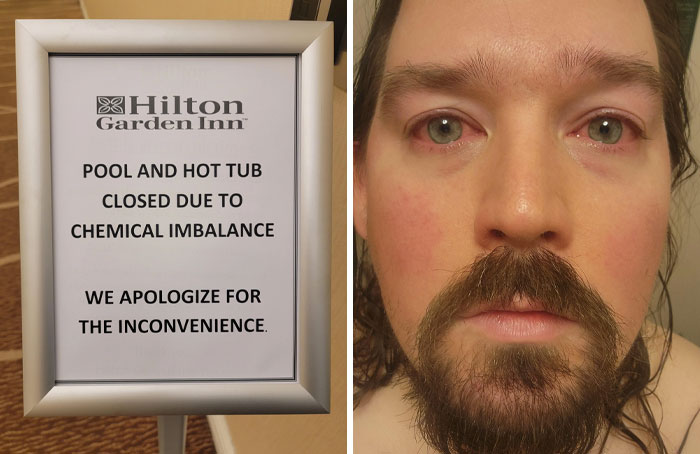 A Hilton Garden Inn sign about pool closure due to chemical imbalance paired with a man showing red irritated eyes.