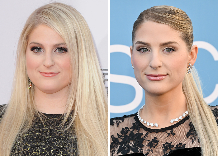 Before-and-after photos of a Meghan Trainor showing the effects of lip flip compared to regular Botox for a natural look.
