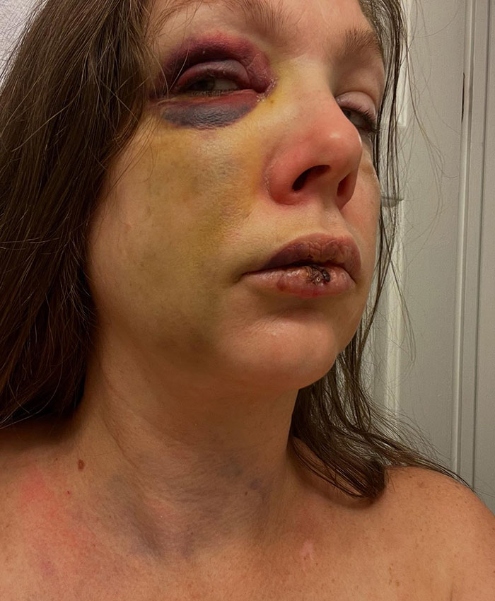 Single mom with bruised face and swollen lips after brutal beating, criticizing police chief's statement in Cincinnati incident. Single mom with bruised face and swollen lips after brutal beating, criticizing police chief's statement in Cincinnati incident.