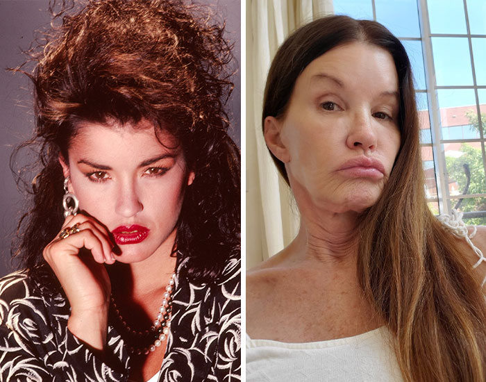 Antes y después de celebridad que muestra los efectos de la cirugía plástica exagerada en su rostro y cuello.