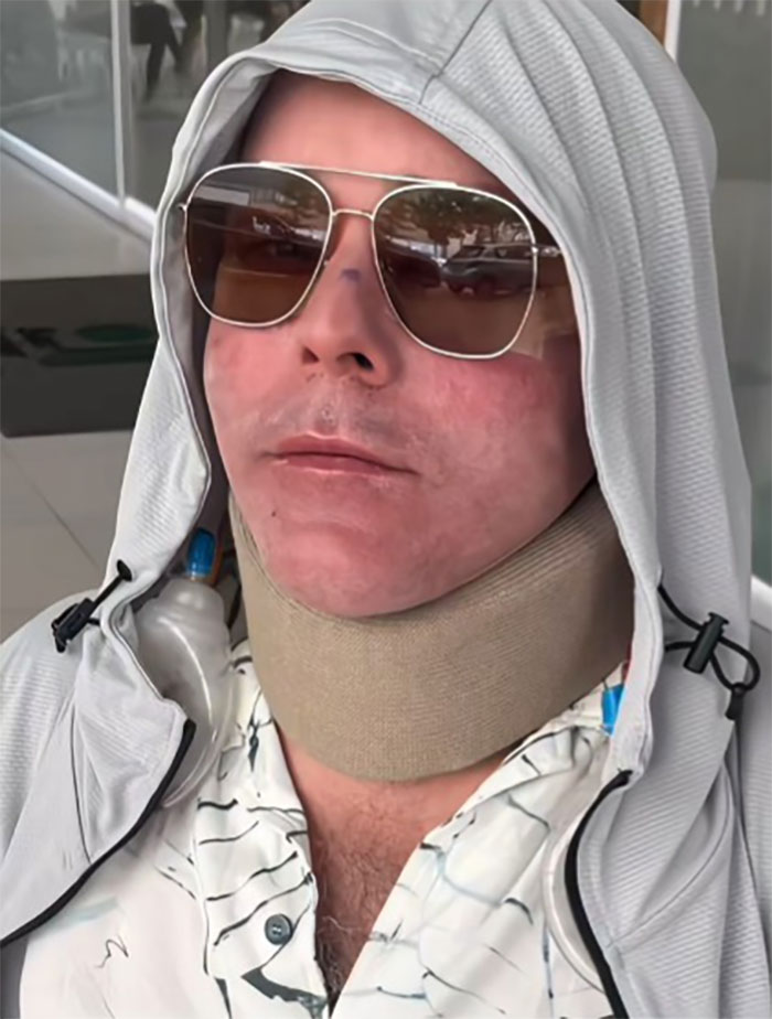 Man wearing sunglasses and a neck brace showing results after a facelift in Mexico in a casual outfit with a hooded jacket. Man wearing sunglasses and a neck brace showing results after a facelift in Mexico in a casual outfit with a hooded jacket.