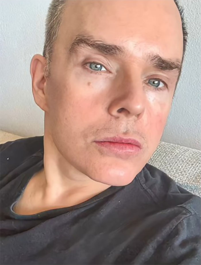 Close-up of a man showing the results of his Mexico facelift with smooth skin and a relaxed expression. Close-up of a man showing the results of his Mexico facelift with smooth skin and a relaxed expression.