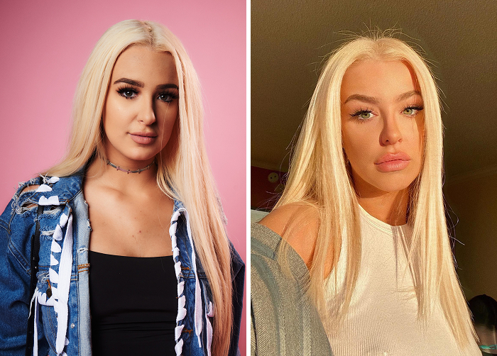 Before and after photos of a Tana Mongeau showing results of lip flip treatment compared to regular Botox for enhanced lip appearance.