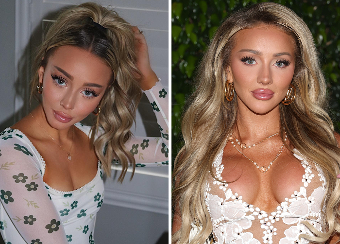 Before and after photos of a Vanna Einerson showcasing the effects of lip flip as an alternative to regular Botox for enhanced lips.