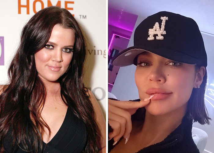 Before and after photos of a Khloe Kardashian who replaced regular Botox with lip flip for a natural enhanced look.