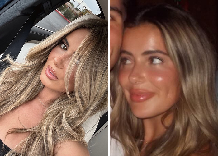 Side-by-side before and after photos of a Brielle Biermann showcasing the effects of lip flip versus regular botox on her lips.
