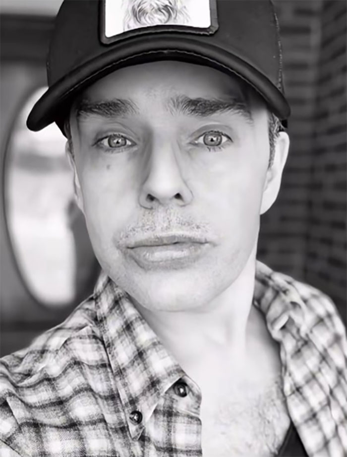 Close-up of a man wearing a cap and plaid shirt showing results after a Mexico facelift with a fresh facial appearance. Close-up of a man wearing a cap and plaid shirt showing results after a Mexico facelift with a fresh facial appearance.