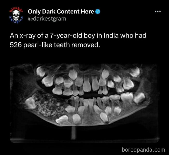 X-ray image showing unusual teeth removal from a 7-year-old boy featured on darkest page on Instagram.