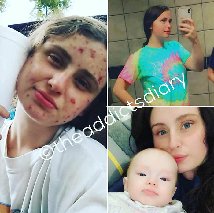 Before-and-after photos showing a young woman recovering and rebuilding her life with improved skin and a happy family.
