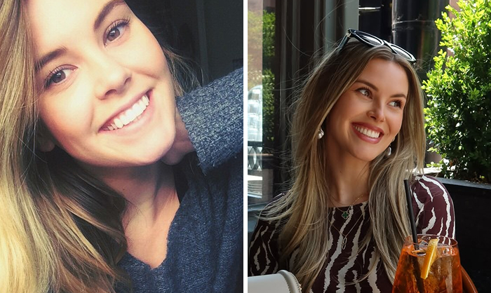 Before-and-after photos of a Anna Redman smiling, showing results of lip flip treatment versus regular Botox.