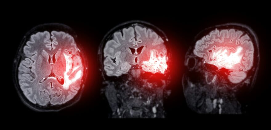 MRI brain scans showing highlighted areas related to strokes and dementia risks warned by neurologist post-exercise habits.