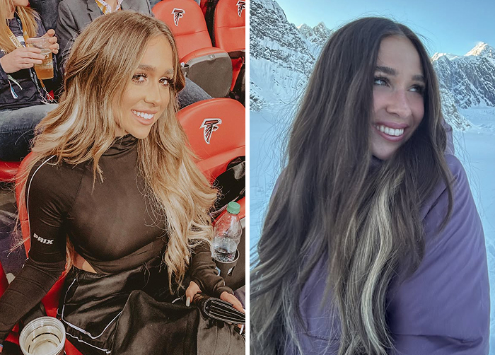 Before and after photos of a Ariana Biermann showing results of replacing regular Botox with lip flip for a natural look.