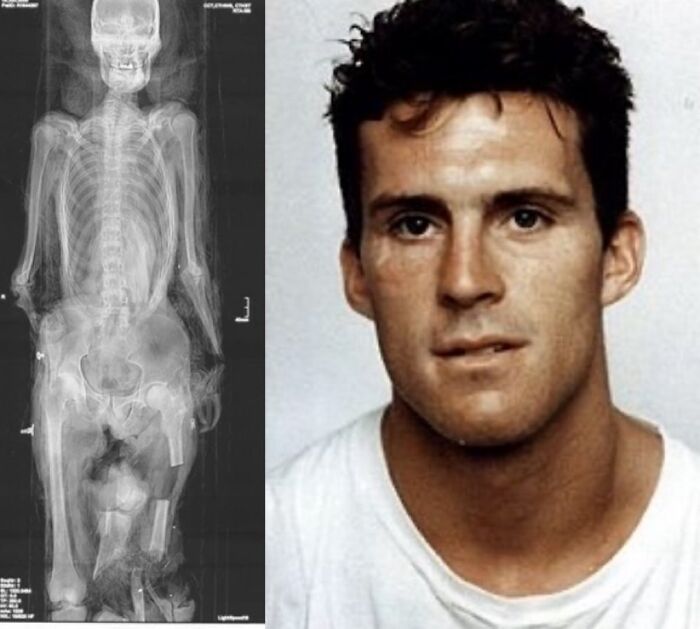 X-ray image of a human skeleton with visible damage alongside a portrait of a young man, unsettling morbid knowledge content.