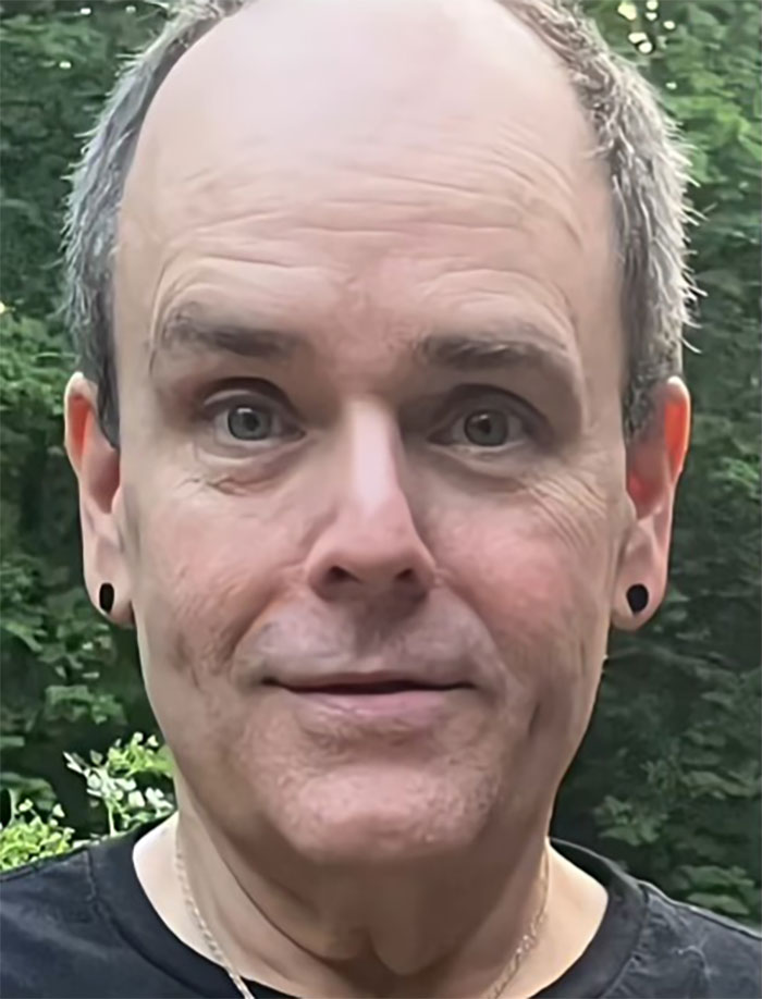 Middle-aged man outdoors showing results of facelift surgery in Mexico with a surprised expression and short hair. Middle-aged man outdoors showing results of facelift surgery in Mexico with a surprised expression and short hair.
