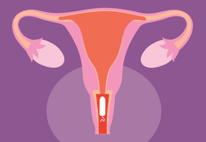 Illustration of female reproductive system showing a tampon left inside the uterus, highlighting tampon-related health risks.