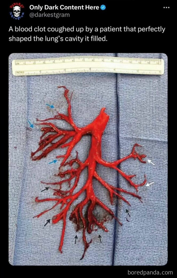 Blood clot shaped like a lung cavity, shared on darkest page on Instagram known for creepy and dark content.