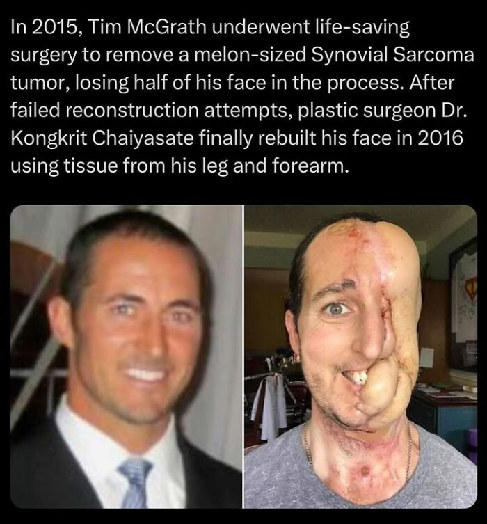 Side-by-side images showing dramatic face changes after life-saving surgery, illustrating creepy facts and pictures.