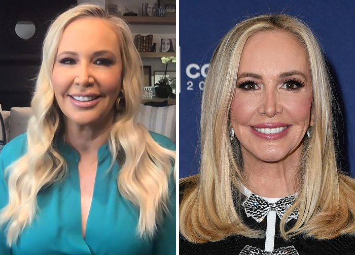 Before-and-after photos of a Shannon Beador showcasing results of lip flip cosmetic treatment replacing regular Botox.