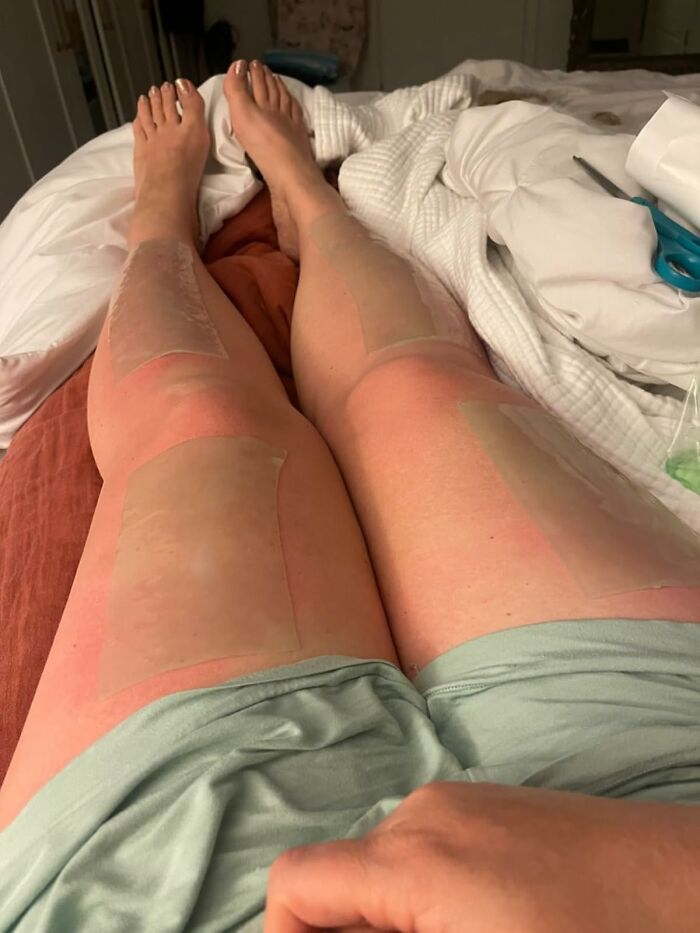 Legs with cooling gel patches applied to sunburned skin as a heatwave hack to relieve summer discomfort.