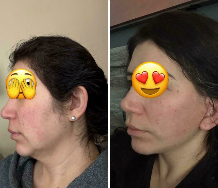 Before and after plastic surgery side profile comparison of a woman showing facial transformation and contour improvement.