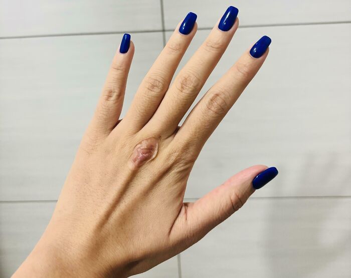 Hand with a prominent and interesting birth mark on the back, featuring blue painted nails against a tiled background.