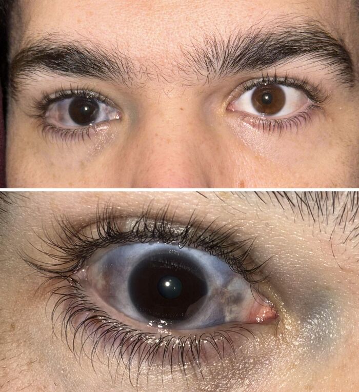 Close-up of a brown eye with a unique birth mark pattern visible on the white of the eye and skin around it.