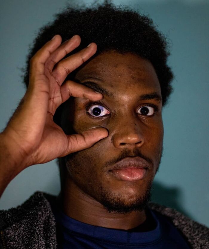 Close-up of a man showing an interesting birth mark on his face with a focused expression against a plain background.