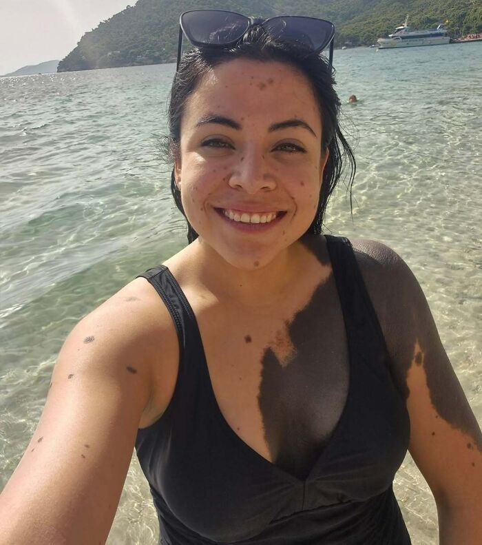 Smiling woman with unique birth marks on her face and arms wearing sunglasses and a black swimsuit at the beach.