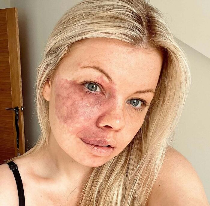 Young woman with a large, unique birthmark covering part of her face, showcasing amazing and interesting birth marks.