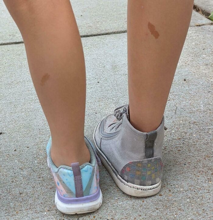 Legs of two children with unique birth marks standing on a sidewalk wearing different colored shoes, showcasing amazing birth marks.