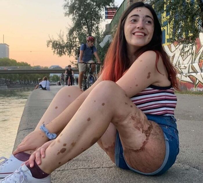 Young woman with unique birth marks on her arms and legs sitting by the riverside at sunset, smiling happily.