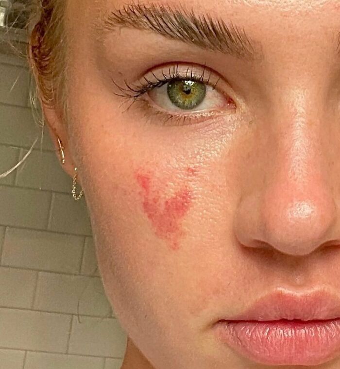 Close-up of a person’s face showing an interesting red birth mark on the cheek near the eye and nose.