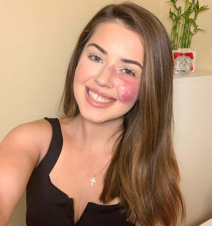 Young woman smiling with an interesting birthmark on her cheek, showcasing unique and amazing birth marks on skin.