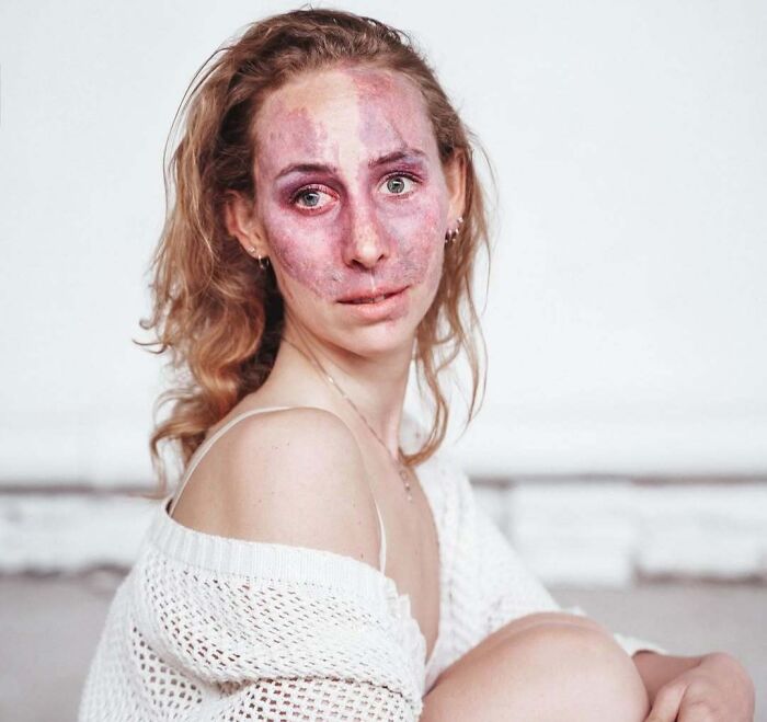 Young woman with an unusual birthmark covering most of her face, sitting in a relaxed pose against a neutral background.