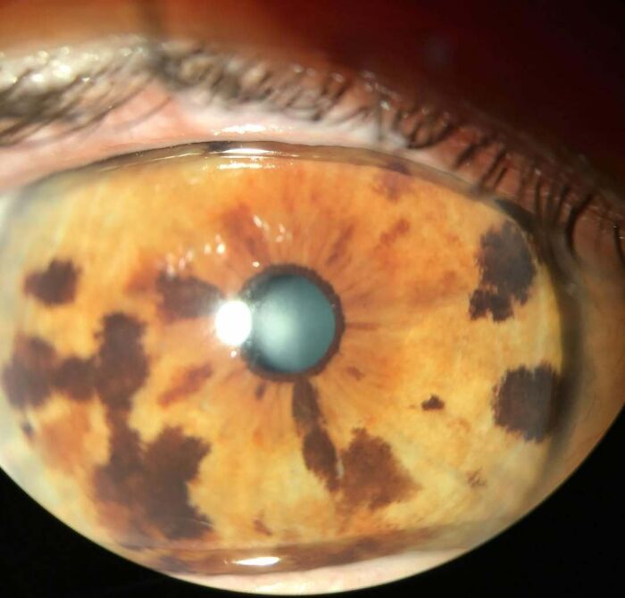 Close-up of an eye with unique brown birth marks on the iris, showcasing interesting birth marks patterns.