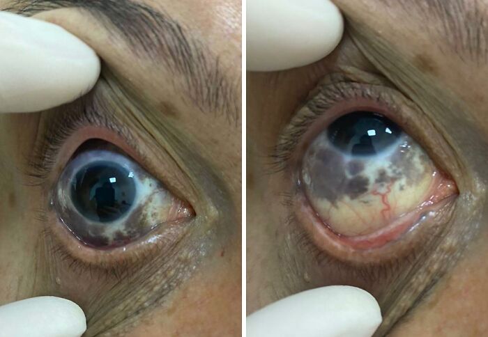 Close-up of a person’s eye showing a unique and interesting birthmark on the sclera, highlighting rare birth marks.