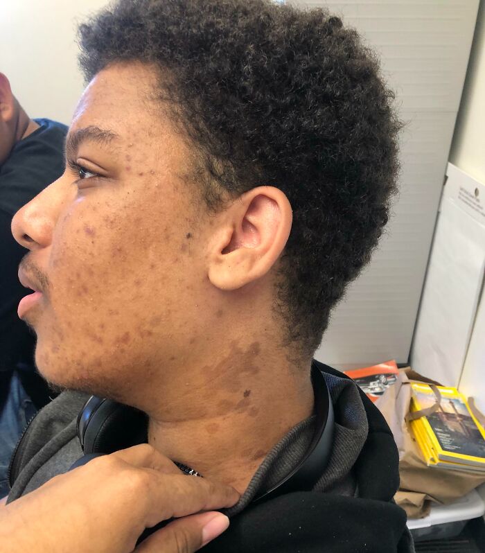 Young man showing unique birth marks on neck and cheek with curly hair in a casual indoor setting.