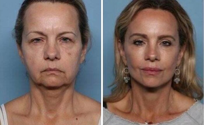 Before and after plastic surgery comparison of a woman showing dramatic transformation and Beverly Hills housewife look.
