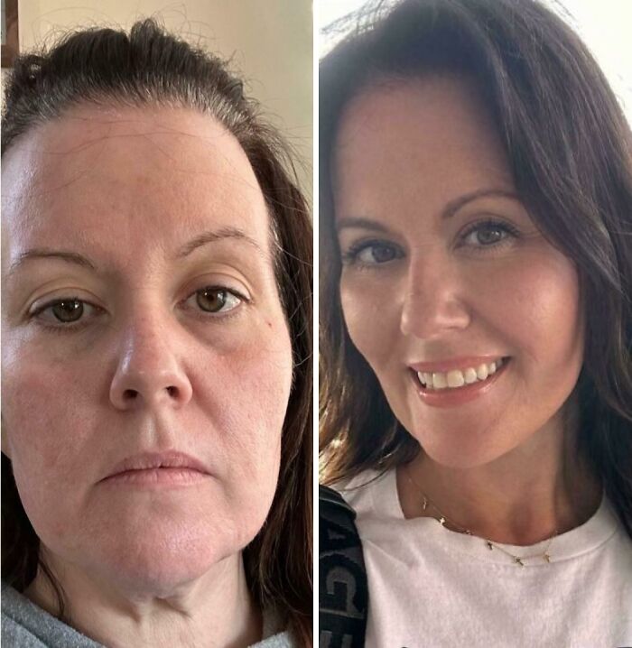 Before and after plastic surgery transformation showing dramatic facial changes and enhanced appearance in close-up portraits.