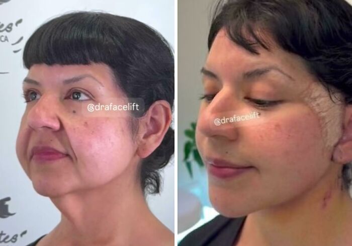 Before and after plastic surgery photos showing a woman’s facial transformation from everyday to Beverly Hills housewife style.