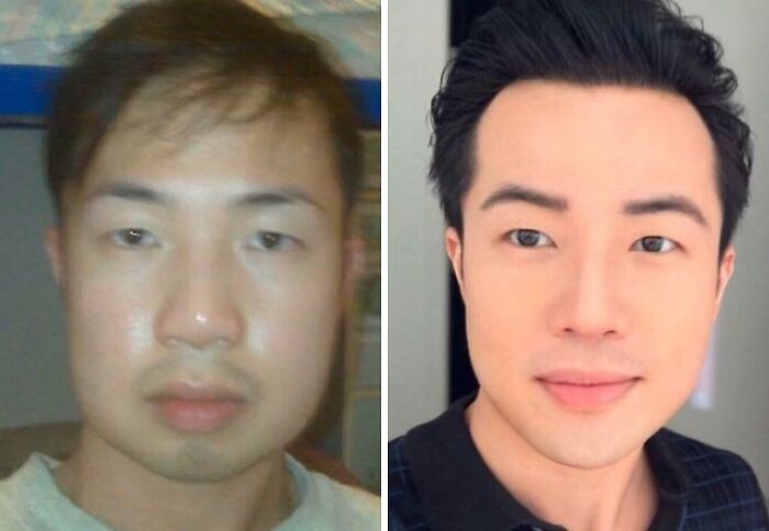 Before and after plastic surgery transformation showing dramatic cosmetic changes in facial features and appearance.