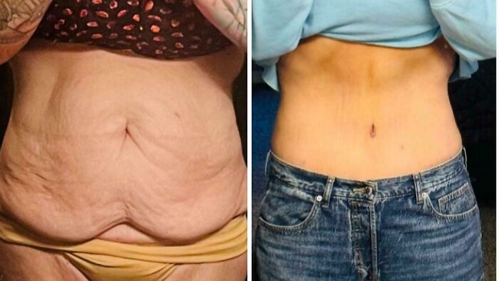 Before and after plastic surgery pics showing dramatic body transformation from mom at Costco to Beverly Hills housewife.