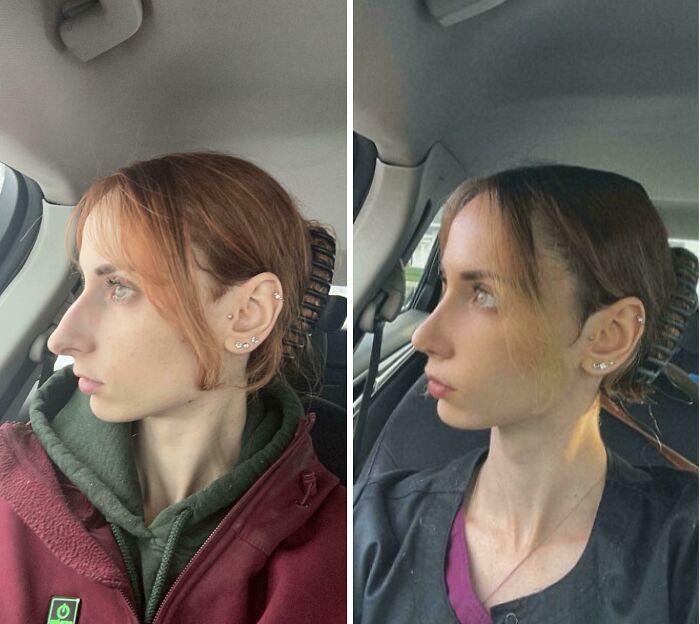 Side-by-side before and after plastic surgery photos showing facial transformation of a young woman in a car.